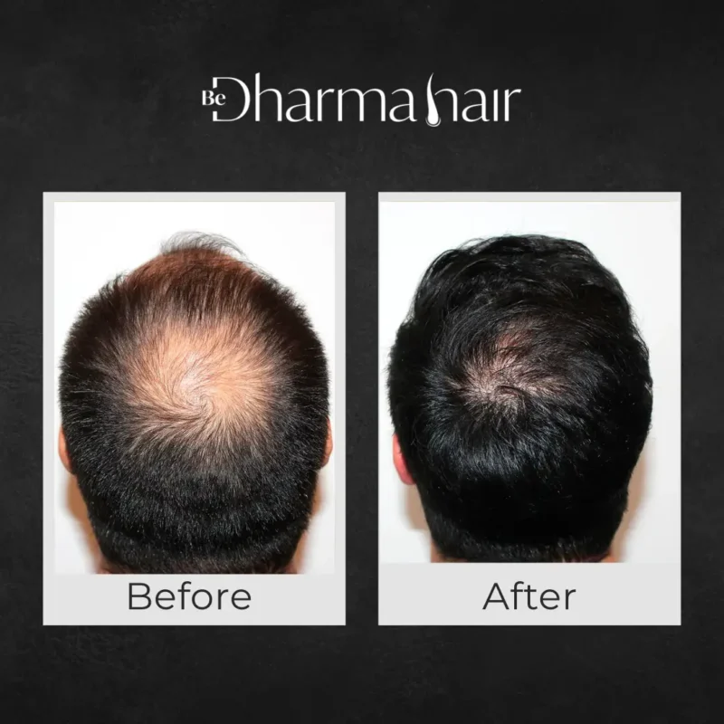 Before and after hair transplant - Dr. David Delgado and Dharma Hair - Colombia
