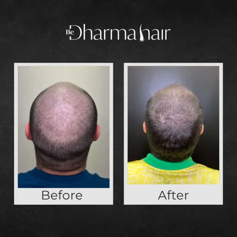 Before and after hair transplant - Dr. David delgado and Dharma Hair - Medellín, Colombia
