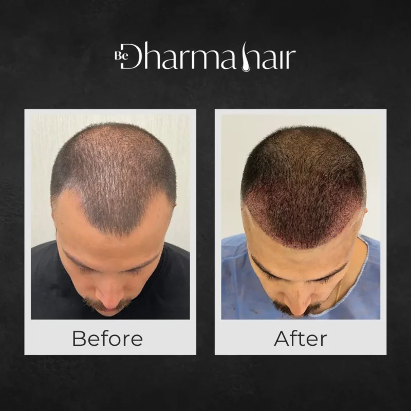 Before and after hair transplant in Colombia - Dr. David Delgado and Dharma Hair - Medellín, Colombia
