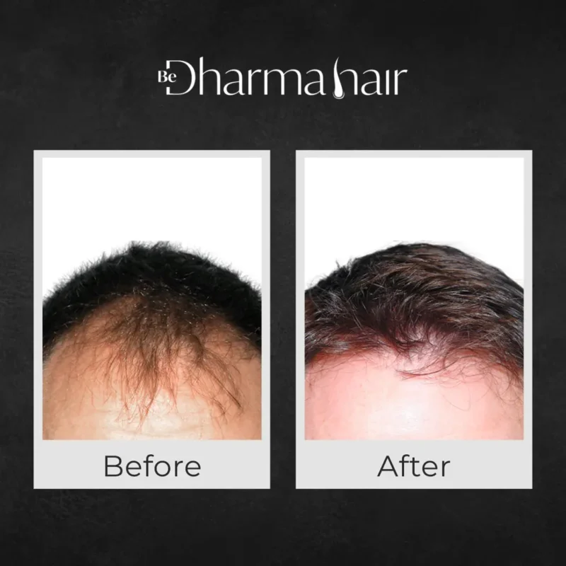Before and after hair transplant in Medellín - Dr. David Delgado and Dharma Hair - Medellín, Colombia