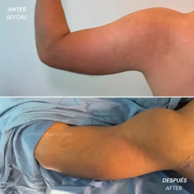 Braquioplastia casos antes y despúes en Medellín- Dr. David Delgado