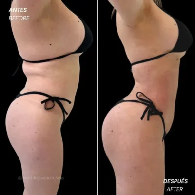 Cuando se ven los resultados de una liposucción antes y después- Dr. David Delgado- Cirujano plástico en Medellín