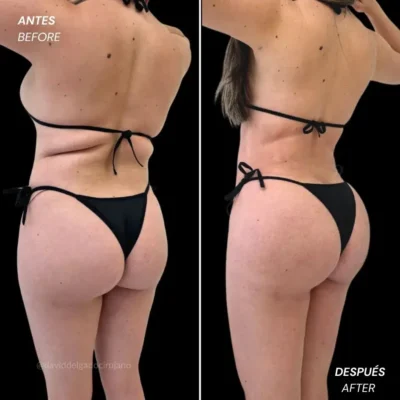 Cuando se ven los resultados de una liposucción antes y después- Dr. David Delgado- Cirujano plástico en Medellín