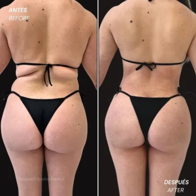 Cuando se ven los resultados de una liposucción antes y después- Dr. David Delgado- Cirujano plástico en Medellín