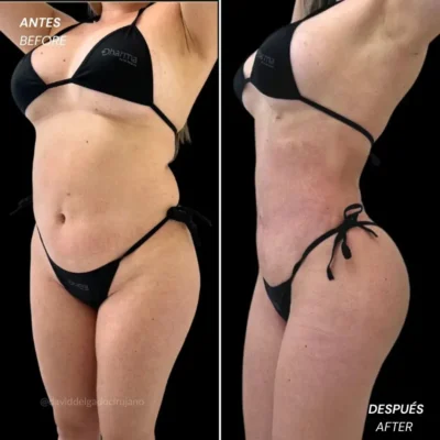 Cuando se ven los resultados de una liposucción antes y después- Dr. David Delgado- Cirujano plástico en Medellín