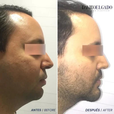 Mentoplastia casos antes y despúes en Medellín- Dr. David Delgado