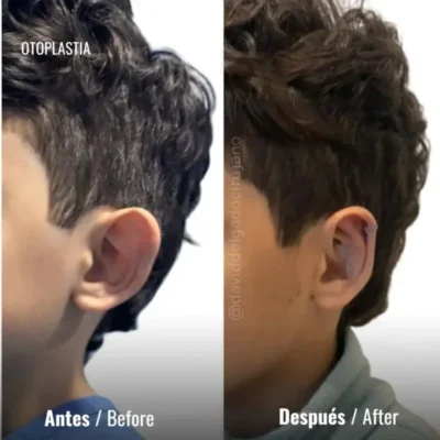 Otoplastia casos antes y despúes en Medellín- Dr. David Delgado