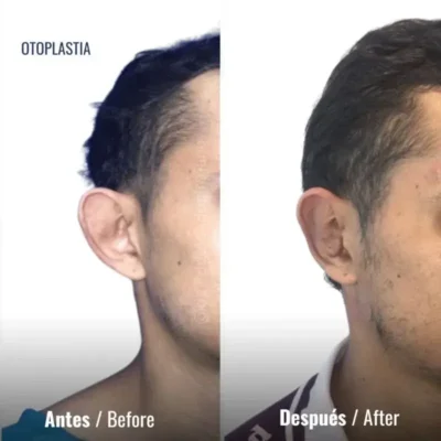 Otoplastia casos antes y despúes en Medellín- Dr. David Delgado
