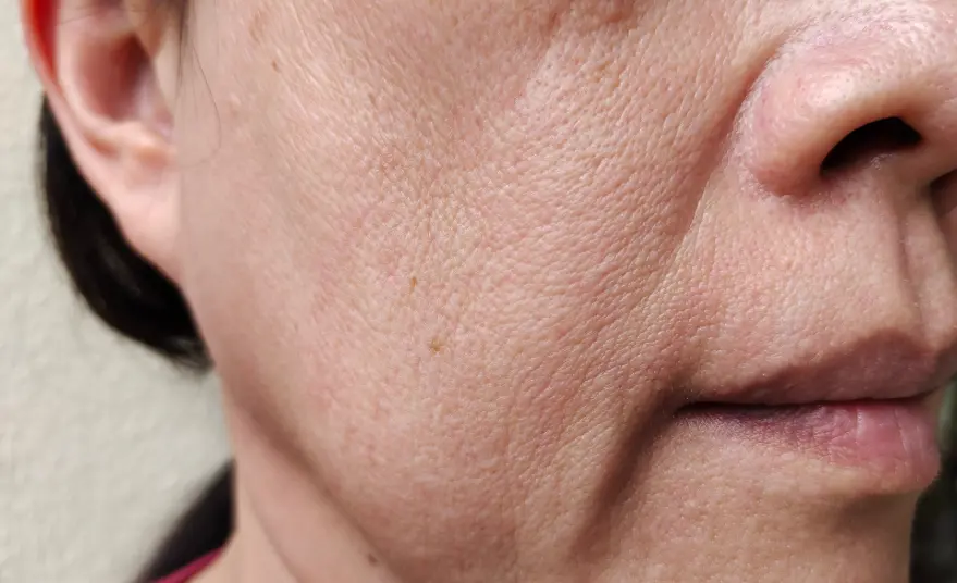 Ozempic Face- Piel flacida-Dr. David Delgado