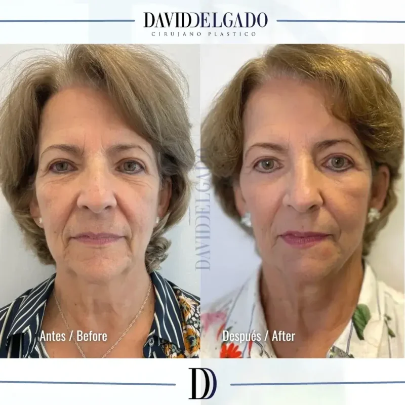 Ozempic Face antes y después- Cirujano plástico en Medellín, Colombia-Dr. David Delgado