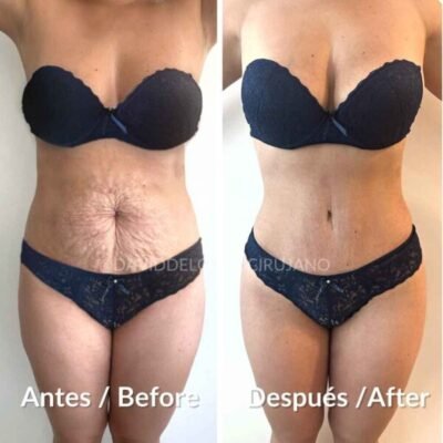 Abdominoplasty before and after with improved waist and abdominal definition in a woman - Dr. David Delgado - Medellin, Colombia