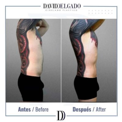Before and after abdominoplasty in a male patient with improved abdominal definition - Dr. David Delgado - Medellin, Colombia