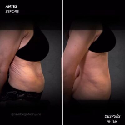 Before and after abdominoplasty showing a more defined abdominal profile in a female patient - Dr. David Delgado - Medellin, Colombia