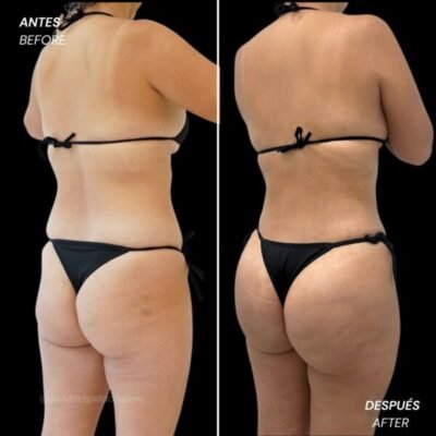 Before and after body contouring with liposuction of the abdomen and waist - Dr. David Delgado - Medellin, Colombia