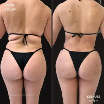Before and after liposuction result focused on abdomen and flanks - Dr. David Delgado - Medellin, Colombia
