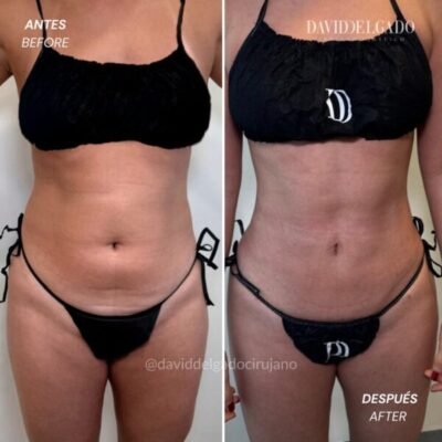 Before and after liposuction showing a more defined abdominal contour - Dr. David Delgado - Medellin, Colombia