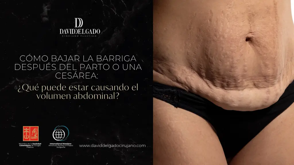 Cómo bajar la barriga después del parto o una cesárea - Dr. David Delgado - Medellín, Colombia