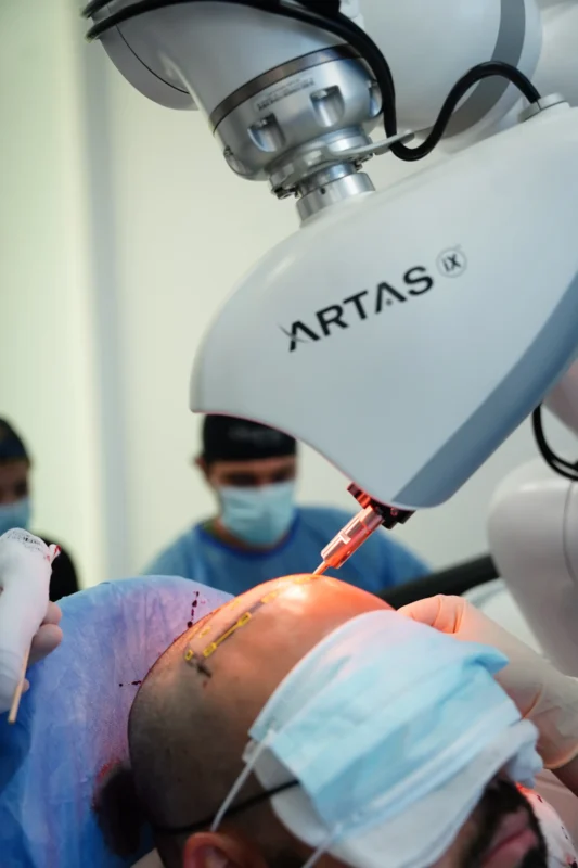 Implante capilar con ARTAS IX en Medellín