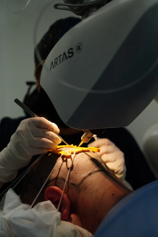 Implante capilar con ARTAS paso 4 - Dr. David Delgado - Be Dharma Hair - Medellín, Colombia