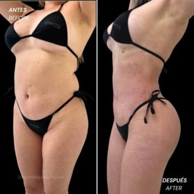 Liposuction before and after for body contour improvement - Dr. David Delgado - Medellin, Colombia