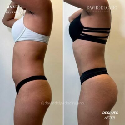 Liposuction before and after showing changes in waist and torso proportions - Dr. David Delgado - Medellin, Colombia