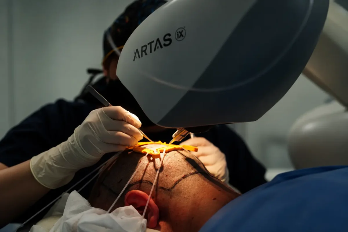 ARTAS iX robotic hair transplant procedure at Be Dharma Hair in Medellín, Colombia
