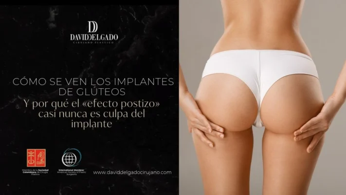 Cómo se ven los implantes de glúteos y por qué el «efecto postizo» casi nunca es culpa del implante - Dr David Delgado
